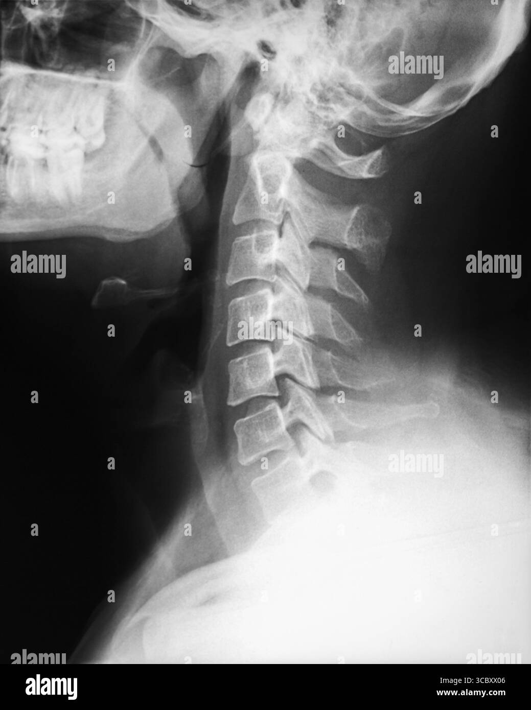 Radiographie IRM du crâne et du rachis cervical. Vue latérale. Banque D'Images