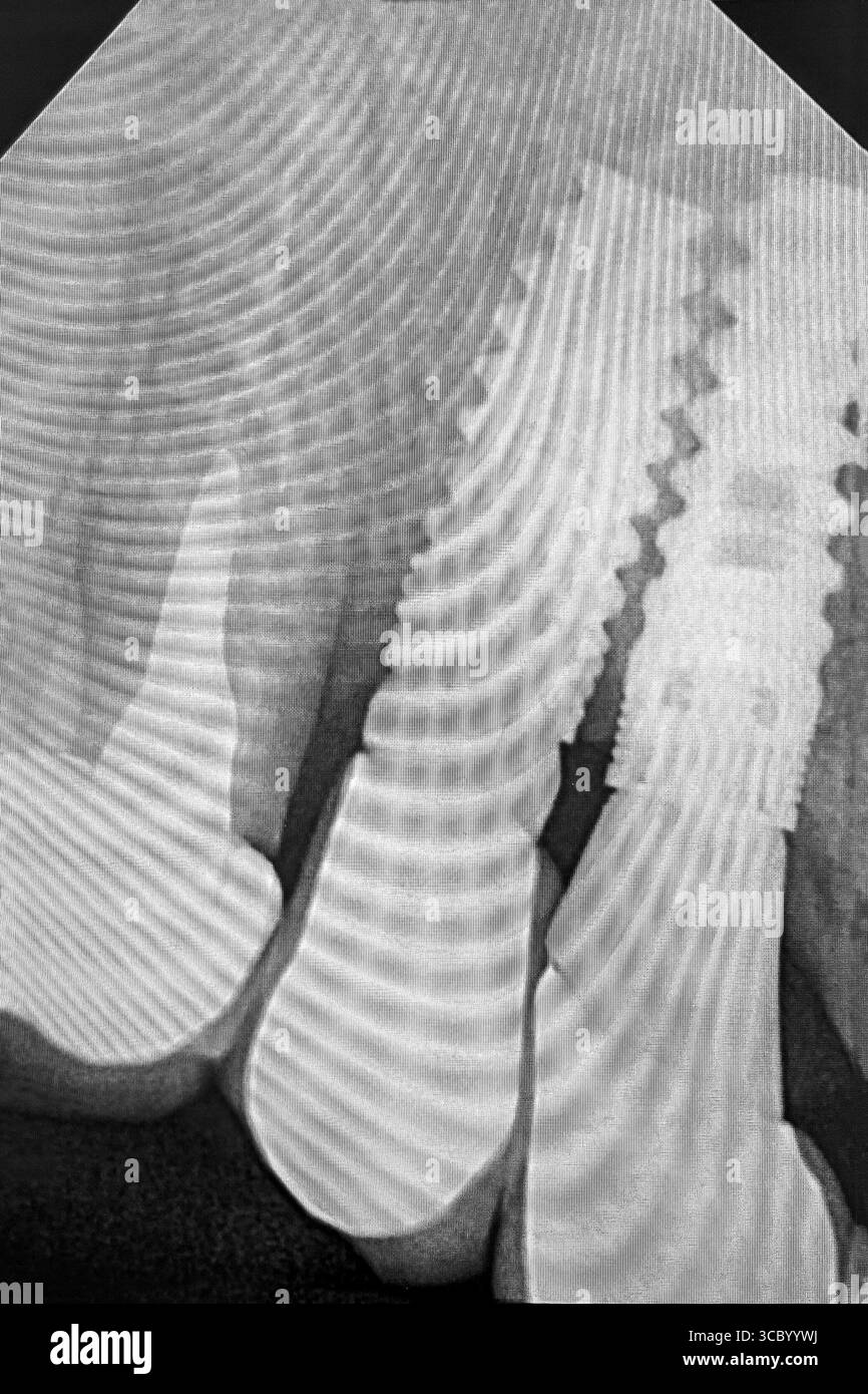 Implants dentaires et dent. Image radiographique en noir et blanc. Banque D'Images