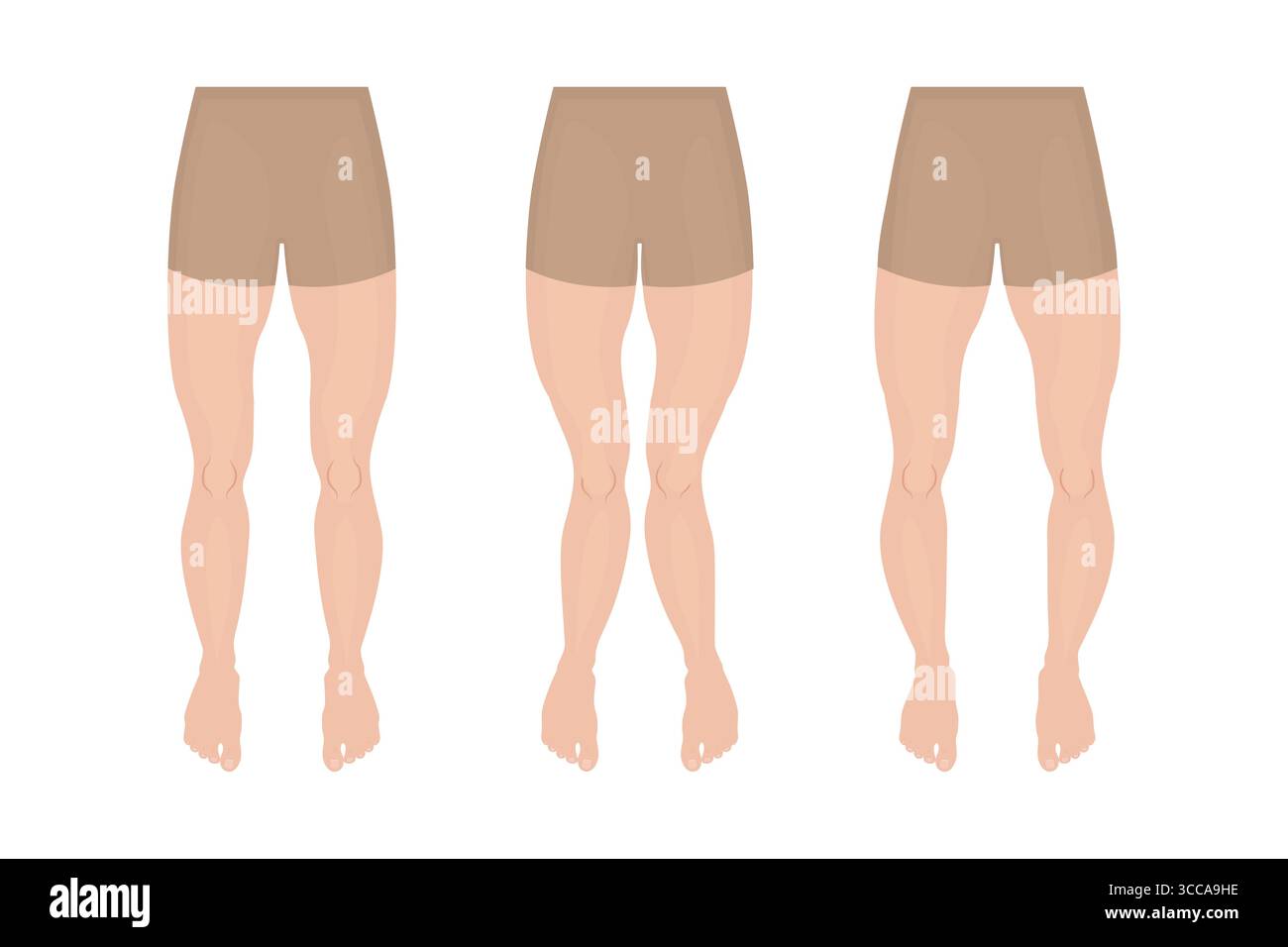 Différentes courbures et déformations des jambes, genu varum, valgum et recurvatum Illustration de Vecteur