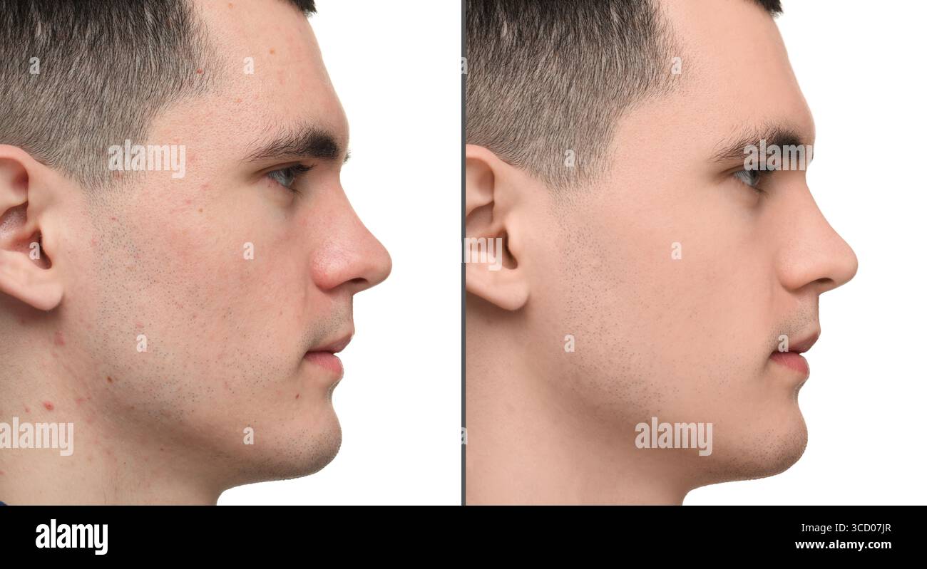Homme avec problème d'acné montrant son visage avant et après le traitement de soins de la peau, gros plan. Collage Banque D'Images