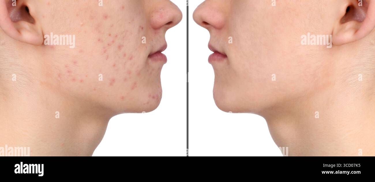 Homme avec problème d'acné montrant son visage avant et après le traitement de soins de la peau, gros plan. Collage Banque D'Images
