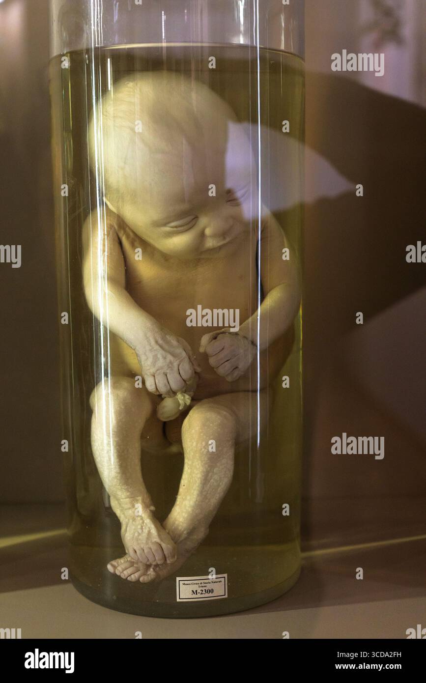 Foetus humain 6 ème mois dans un récipient en verre avec formol. Musée civique d'histoire naturelle de Trieste Banque D'Images Foetus humain 6 ème mois dans un récipient en verre avec formol. Musée civique d'histoire naturelle de Trieste Banque D'Images