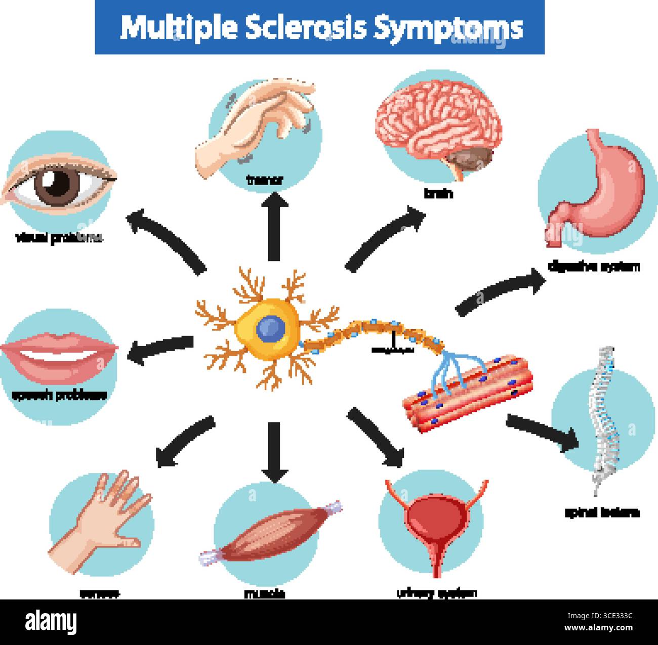 Illustration vectorielle médicale montrant les symptômes de sclérose en plaques avec des icônes étiquetées pour le cerveau, les lésions spinales, le muscle, les sens et le système corporel affecté Illustration de Vecteur