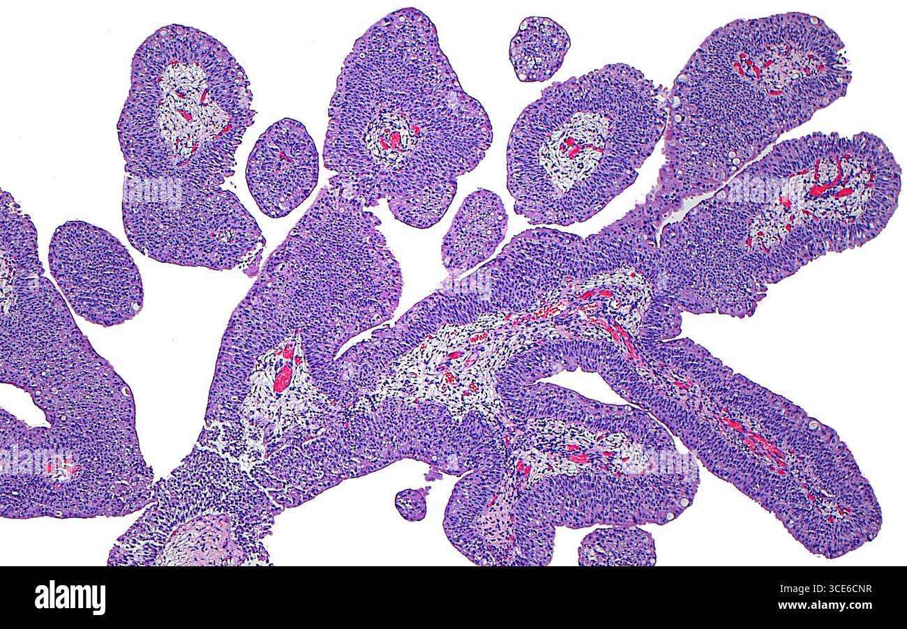 Papillome urothélial par micrographie à la lumière. Un papillome urothélial est une croissance bénigne qui se produit dans les voies urinaires. Le papillome est composé de fines papilles ou de structures en forme de doigts, avec des noyaux fibrovasculaires (blancs avec des stries rouges vives) et bordés de cellules urothéliales bénignes (violettes). Coupe de tissu colorée à l'hématoxyline et à l'éosine. Grossissement : 40x lorsqu'il est imprimé à 10cm. Banque D'Images