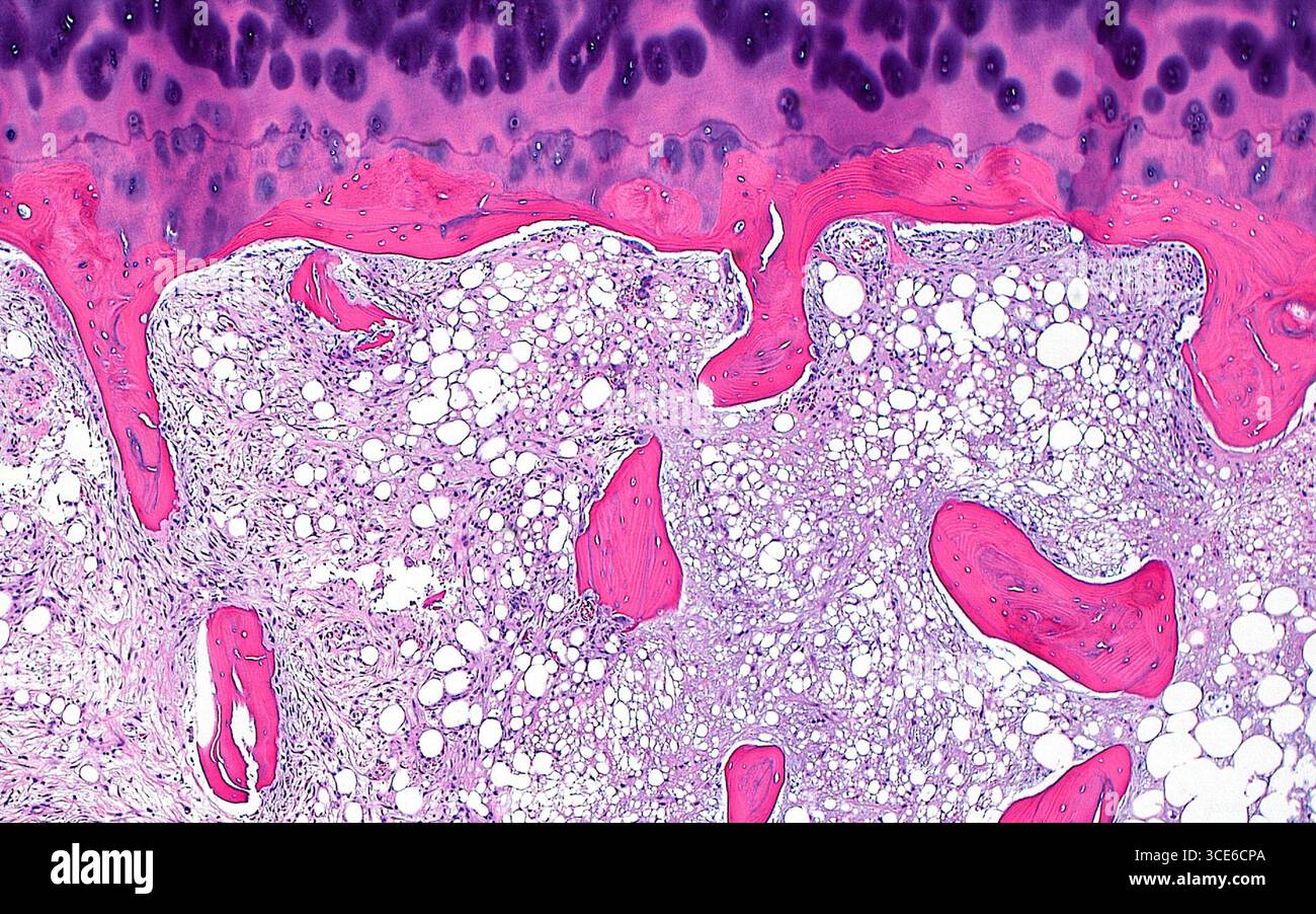 Micrographie lumineuse des nécroses avasculaires. La nécrose avasculaire se manifeste dans les os par une nécrose graisseuse dans l'espace médullaire (zones bleu-gris pâle) entre les trabécules osseuses (rose vif). Une partie du cartilage articulaire (rose-violet), qui est le cartilage qui recouvre la surface osseuse d'une articulation, est visible en haut de l'image. Coupe de tissu colorée à l'hématoxyline et à l'éosine. Grossissement : 40x lorsqu'il est imprimé à 10cm. Banque D'Images