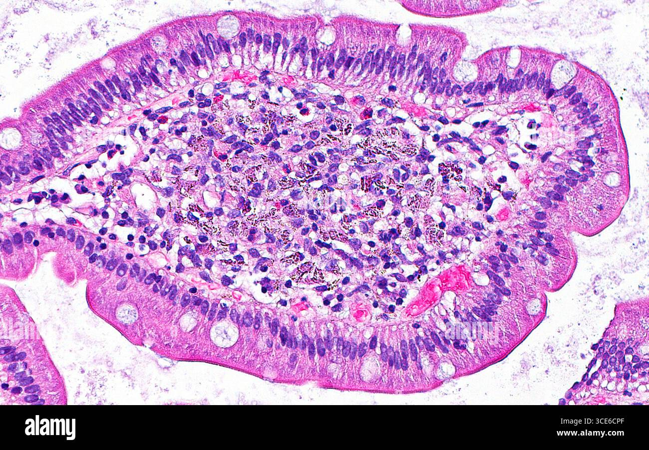 Micrographie à la lumière des dépôts de lanthane dans une villosité duodénale. Le carbonate de lanthane est un médicament utilisé pour réduire les taux anormalement élevés de phosphate dans le sang. Chez certains patients prenant du carbonate de lanthane, le lanthane peut se déposer dans le duodénum et causer des symptômes chez ces patients. Dans cette image, les dépôts de lanthane sont les nombreux petits points brun-rouge brillants dans une villosité duodénale (la structure approximativement ovoïde occupant la majeure partie de l'image). Coupe de tissu colorée à l'hématoxyline et à l'éosine. Grossissement : 200x lorsqu'il est imprimé à 10cm. Banque D'Images