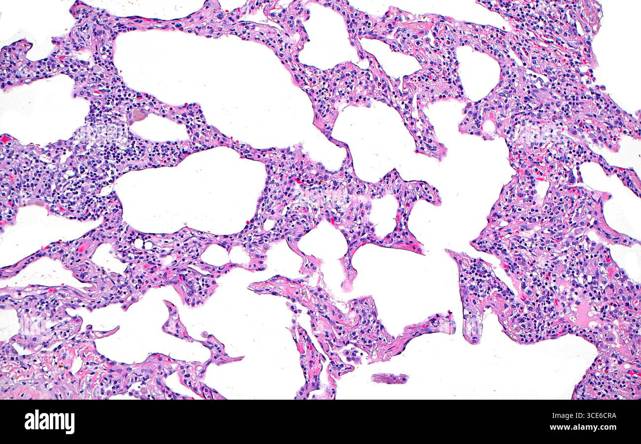 L'inflammation septale pulmonaire par micrographie lumineuse. Lorsque le tissu pulmonaire est blessé, l'un des modèles de réaction inflammatoire est l'inflammation septale. Dans l'inflammation septale, les septa qui sont les zones entre les espaces alvéolaires (blancs), sont dilatés par de nombreuses cellules inflammatoires. (beaucoup de petits points bleus). Coupe de tissu colorée à l'hématoxyline et à l'éosine. Grossissement : 100x lorsqu'il est imprimé à 10cm. Banque D'Images