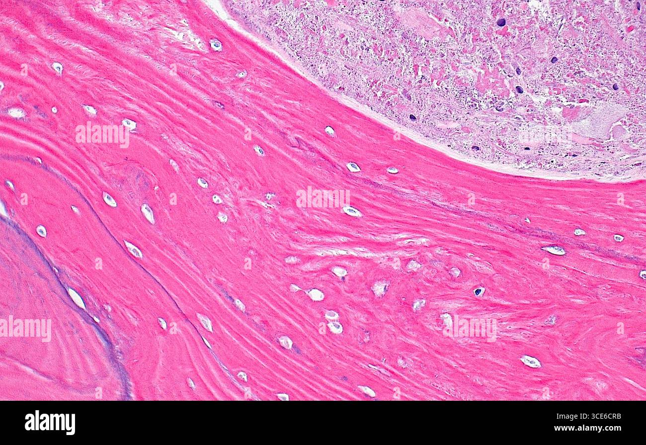 Micrographie légère de l'ostéonécrose, qui est la mort du tissu osseux. L'ostéonécrose peut survenir de diverses causes qui blessent l'os. Microscopiquement, l'os mort présente des espaces lacunaires (points blancs sur fond rose vif) avec des noyaux d'ostéocytes (cellules osseuses) absents. Il y a aussi des débris dégénératifs dans l'espace médullaire (coin supérieur droit de l'image). Coupe de tissu colorée à l'hématoxyline et à l'éosine. Grossissement : 200x lorsqu'il est imprimé à 10cm. Banque D'Images