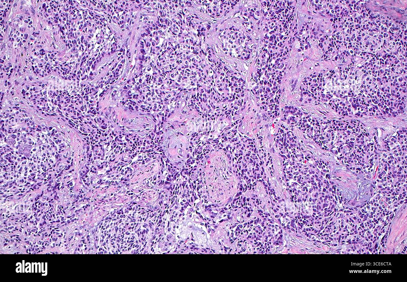 Micrographie lumineuse d'une tumeur carcinoïde neuroendocrine du poumon. Le poumon est un site commun de survenue de tumeurs neuroendocrines. Les cellules tumorales ont de petits noyaux ronds (bleu foncé) et des quantités modérées de cytoplasme (bleu-rose plus clair autour des points bleus). Les cellules tumorales sont disposées en grappes avec du tissu conjonctif intermédiaire (zones bleu rose plus clair). Coupe de tissu colorée à l'hématoxyline et à l'éosine. Grossissement : 100x lorsqu'il est imprimé à 10cm. Banque D'Images