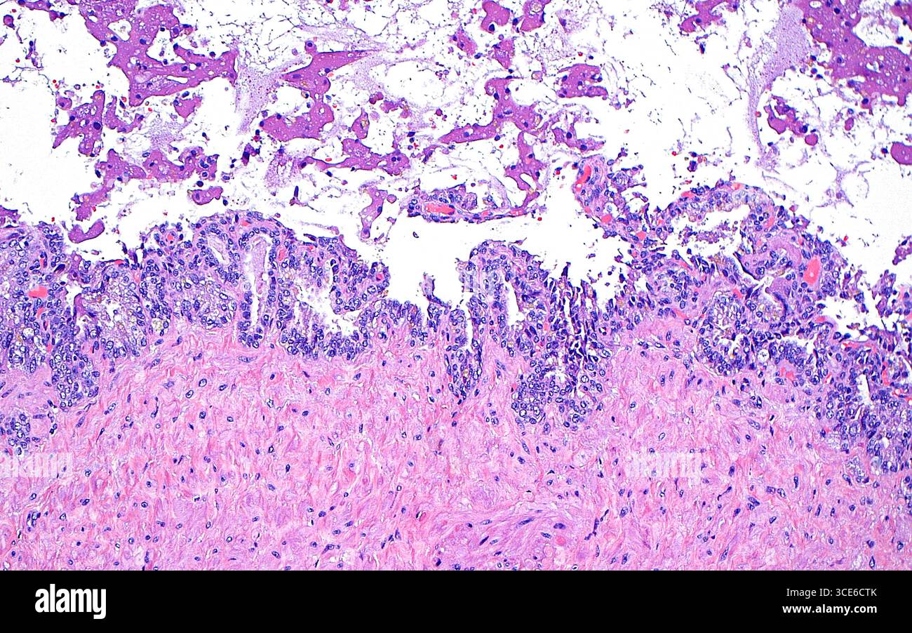 Micrographie lumineuse de la vésicule séminale. La vésicule séminale est l'une des structures du tractus génito-urinaire masculin qui sécrète les fluides qui accompagnent le sperme. La vésicule séminale comprend une paroi musculaire lisse (rose, tiers inférieur de l'image) et une doublure épithéliale (bande horizontale bleu-violet au milieu de l'image). La lumière de la vésicule séminale (blanche, moitié supérieure de l'image) contient des sécrétions (irrégulières rose plus foncé). Coupe de tissu colorée à l'hématoxyline et à l'éosine. Grossissement : 100x lorsqu'il est imprimé à 10cm. Banque D'Images