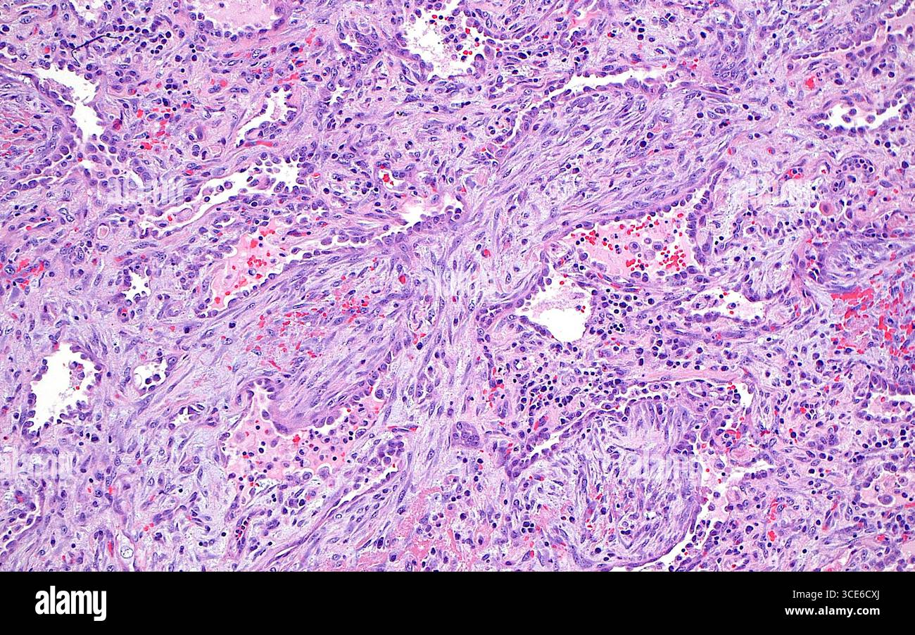 La micrographie à la lumière des pneumonies organisatrices. La pneumonie organisatrice est un modèle de lésion pulmonaire dans lequel les fibroblastes (lignes violettes allongées et sinueuses) prolifèrent et remplissent les espaces dans les alvéoles (espaces blancs). On peut également voir sur cette image d'autres cellules inflammatoires (points bleu foncé) et globules rouges (points rouge vif). Coupe de tissu colorée à l'hématoxyline et à l'éosine. Grossissement : 100x lorsqu'il est imprimé à 10cm. Banque D'Images