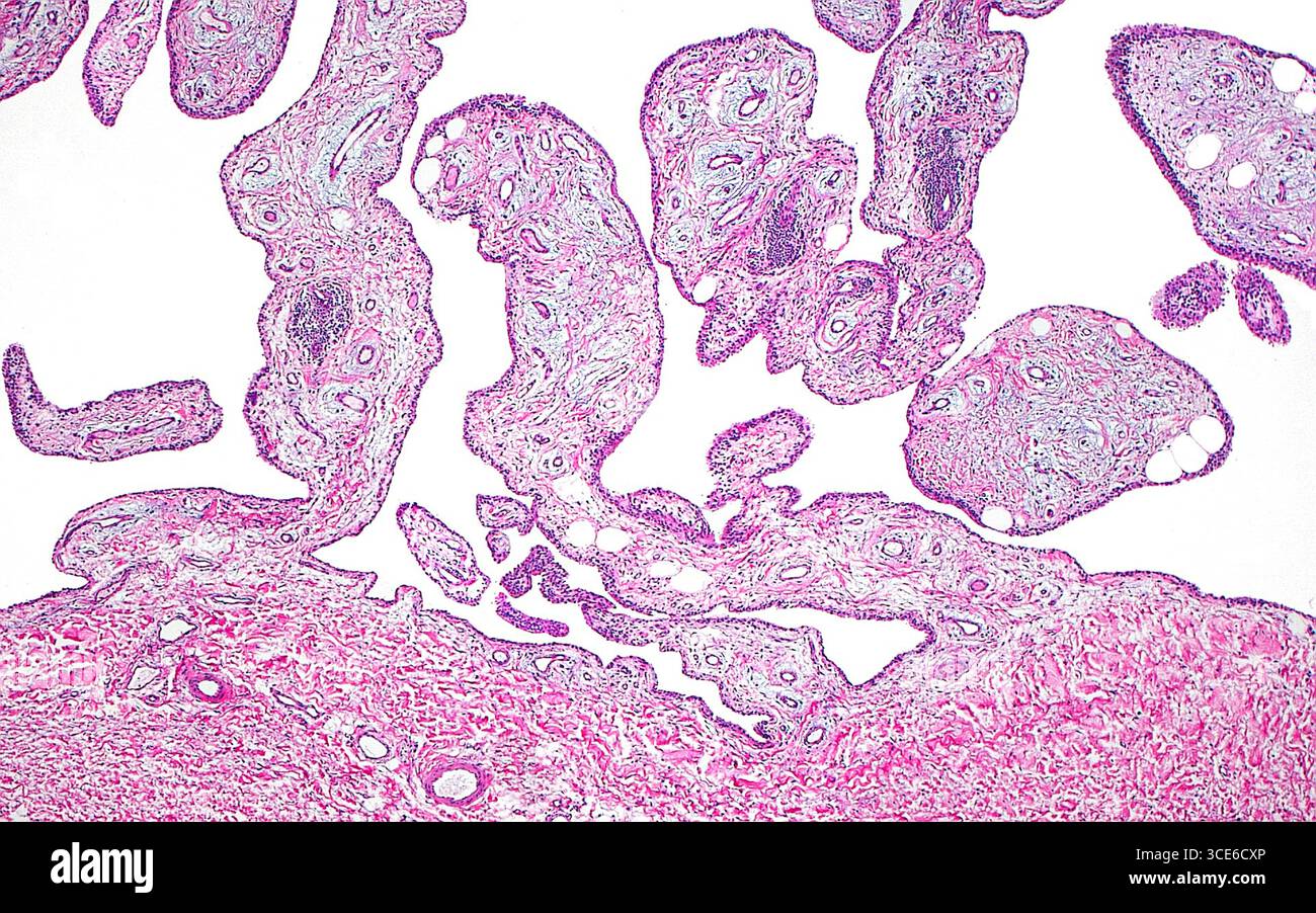 Micrographie lumineuse d'une hyperplasie synoviale papillaire. Dans les maladies articulaires dégénératives telles que l'arthrose, la membrane synoviale tapissant l'espace articulaire peut subir une hyperplasie synoviale papillaire. La synoviale montre alors de nombreuses projections papillaires ou en forme de doigts, comme celles que l'on voit sur cette image. Les papilles ont des noyaux de tissu conjonctif (rose à bleu clair) et sont bordées par une fine couche de cellules synoviales (contours bleu-violet légèrement plus foncés des papilles). Coupe de tissu colorée à l'hématoxyline et à l'éosine. Grossissement : 40x lorsqu'il est imprimé à 10cm. Banque D'Images