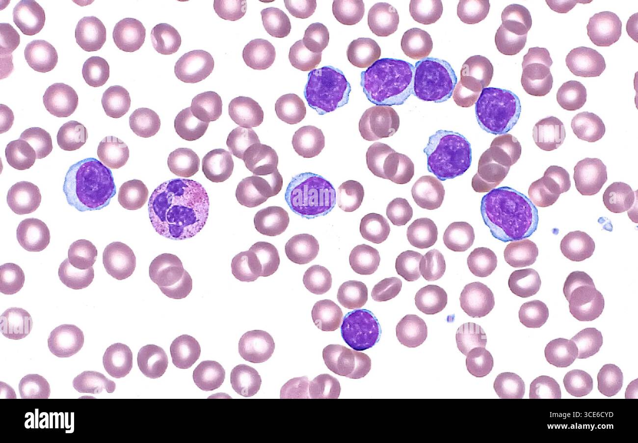 Micrographie légère de la leucémie lymphocytaire de petite taille, qui est un type de cancer du sang. Les cellules leucémiques sont les structures rondes violet foncé et bleu dont neuf sont visibles dans le champ de cette image. Un neutrophile légèrement plus grand est également présent (à droite de la première cellule leucémique à l'extrême gauche de l'image). Plusieurs globules rouges (petits cercles rouges pâles) sont visibles en arrière-plan. Frottis de sang périphérique. Grossissement : 600x lorsqu'il est imprimé à 10cm. Banque D'Images