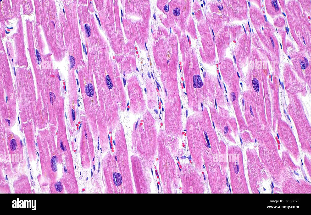 Micrographie lumineuse de l'hypertrophie cardiomyocytaire. Les cardiomyocytes (brins roses occupant la majeure partie de cette image) sont les cellules qui composent le muscle cardiaque. En cas de blessure chronique ou de stress, les cellules du muscle cardiaque deviennent agrandies comme en témoigne leur noyau élargi et irrégulier (points bleu-violet), comme on le voit sur cette image. Coupe de tissu colorée à l'hématoxyline et à l'éosine. Grossissement : 200x lorsqu'il est imprimé à 10cm. Banque D'Images