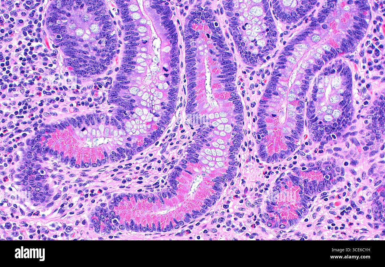 Métaplasie cellulaire de Paneth, micrographie lumineuse Banque D'Images