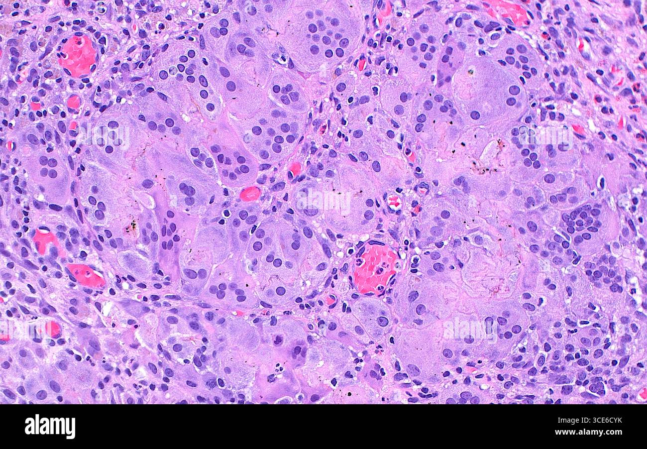 Micrographie lumineuse de cellules histiocytaires géantes multinucléées. Ces cellules ont plusieurs noyaux (points bleus ronds) dans leur cytoplasme (rose à bleu clair). Ces cellules se forment à partir de la fusion de nombreux macrophages tissulaires en réponse à des corps étrangers ou dans d'autres conditions inflammatoires. Cette image montre également quelques petits vaisseaux sanguins contenant des globules rouges (rouge vif). Coupe de tissu colorée à l'hématoxyline et à l'éosine. Grossissement : 200x lorsqu'il est imprimé à 10cm. Banque D'Images