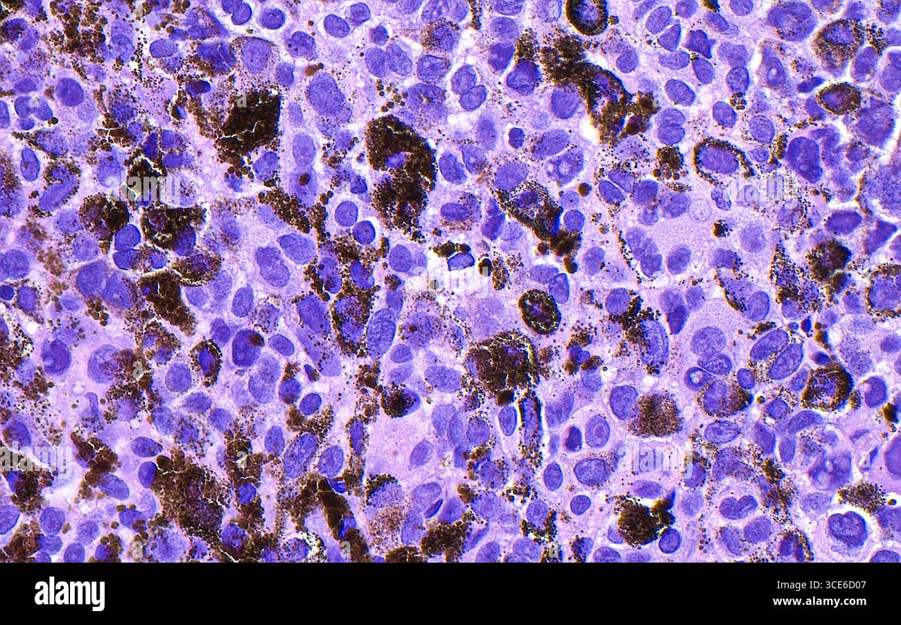 Micrographie lumineuse d'un mélanome malin. Le mélanome est un cancer qui provient des mélanocytes, ou cellules qui produisent le pigment mélanique, le plus souvent de la peau. Les cellules de mélanome (violettes) sont ici en train de produire un pigment mélanique (brun foncé-noir). Coupe de tissu colorée à l'hématoxyline et à l'éosine. Grossissement : 400x lorsqu'il est imprimé à 10cm. Banque D'Images