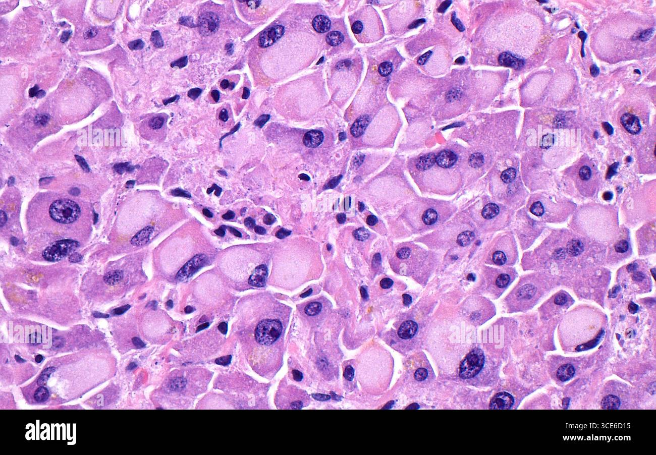 Micrographie à la lumière des inclusions de verre broyé de cellules hépatiques. Des inclusions de verre broyé (structures ovoïdes rose pâle) peuvent être observées dans les cellules hépatiques (rose plus foncé) des patients atteints d'hépatite B, de greffes de foie ou prenant certains médicaments. Les noyaux des cellules hépatiques sont les plus petites structures rondes violettes foncées à côté des inclusions de verre broyées, qui sont dans le cytoplasme des cellules hépatiques. Coupe de tissu colorée à l'hématoxyline et à l'éosine. Grossissement : 600x lorsqu'il est imprimé à 10cm. Banque D'Images