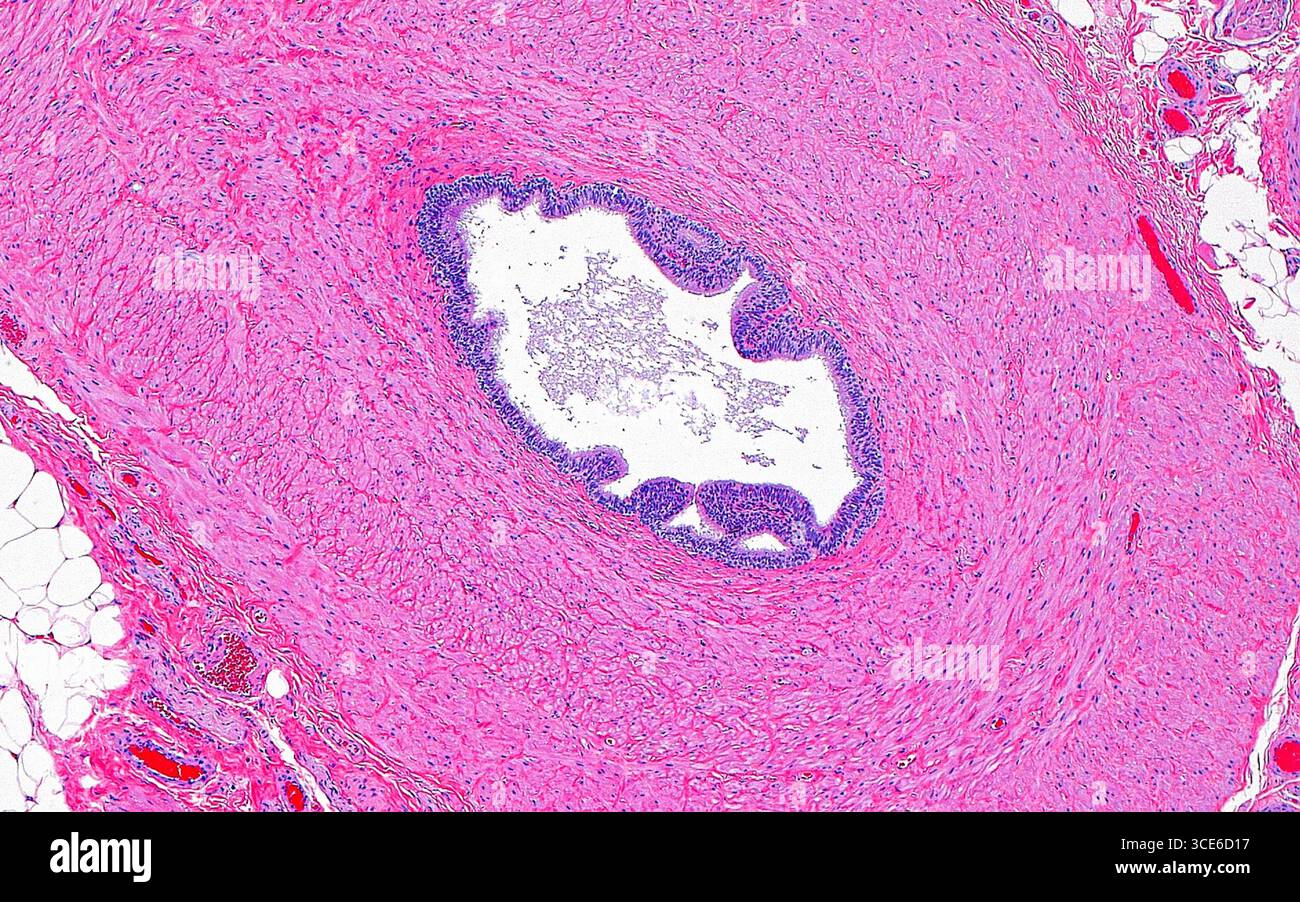 Micrographie légère du canal déférent, vue ici en coupe transversale. Le canal déférent transporte les spermatozoïdes du testicule et les dépose dans l'urètre à l'intérieur de la prostate. Il se compose d'une couche épithéliale (violette) tapissant sa lumière (blanche, centre de l'image) et a des couches perpendiculaires de muscle lisse (rose) qui composent sa paroi. Également visibles sur les bords de l'image sont quelques cellules graisseuses, tissu conjonctif fibreux, et de petits vaisseaux sanguins qui sont présents à l'extérieur de la paroi du canal déférent. Coupe de tissu colorée à l'hématoxyline et à l'éosine. Grossissement : 40x lorsqu'il est imprimé à 10cm. Banque D'Images