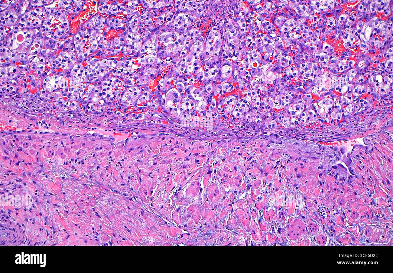 Micrographie lumineuse d'un thrombus tumoral d'un carcinome à cellules rénales. Cette image montre un thrombus de carcinome rénal à cellules claires (moitié supérieure de l'image) attaché à la paroi de la veine rénale (moitié inférieure de l'image). La thrombose des cellules tumorales dans la veine rénale indique un stade de cancer plus élevé et une tumeur plus agressive. Coupe de tissu colorée à l'hématoxyline et à l'éosine. Grossissement : 100x lorsqu'il est imprimé à 10cm. Banque D'Images