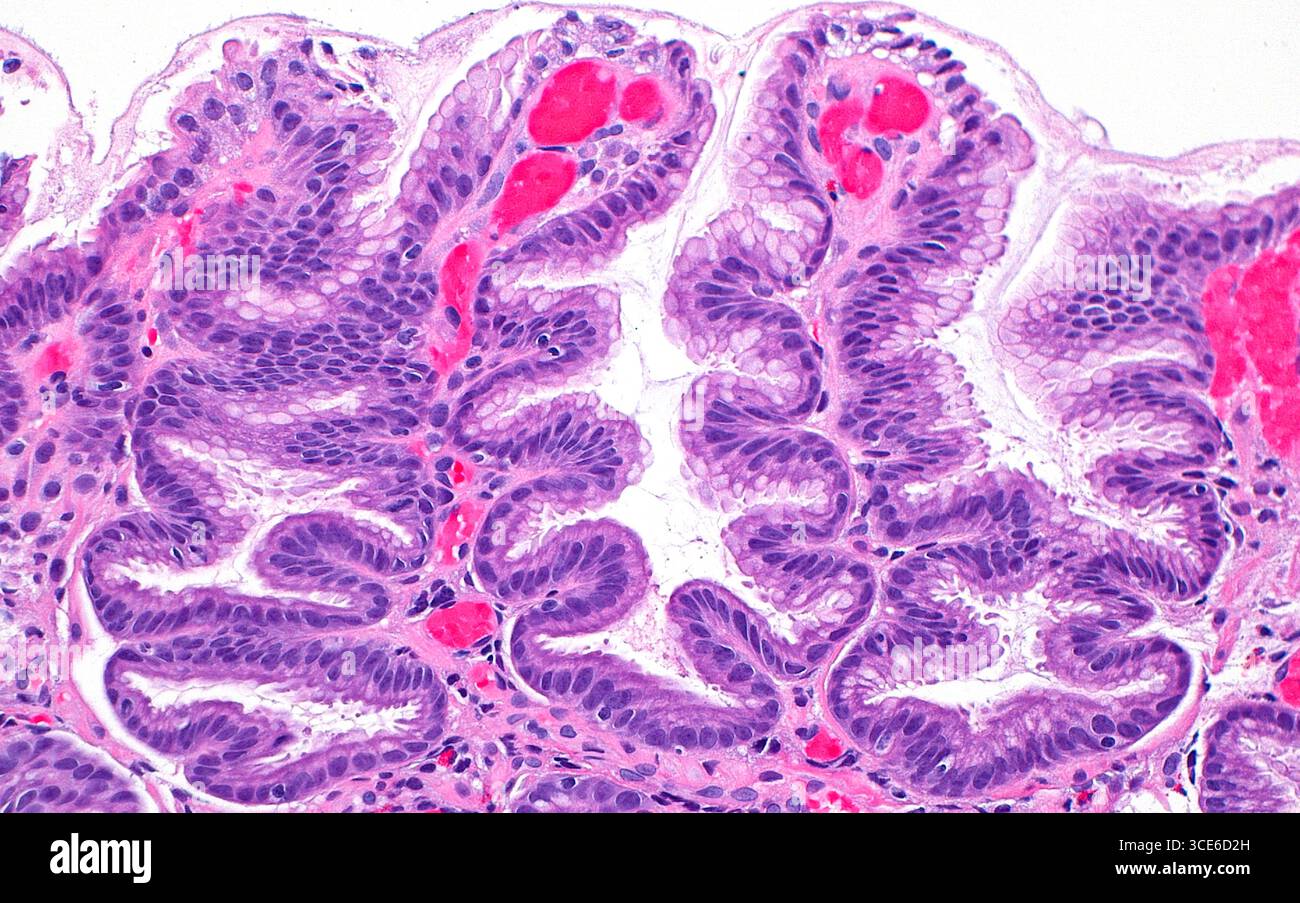 Hyperplasie fovéolaire par micrographie à la lumière. L'épithélium fovéolaire est constitué des cellules tapissant l'estomac. Lorsqu'elle est irritée ou blessée, la muqueuse fovéolaire peut subir une hyperplasie réactive, dans laquelle elle prend un aspect ondulé ou tortueux comme on le voit sur l'image. Les cellules fovéolaires ont un cytoplasme myxoïde clair (blanc à gris clair). Le tissu conjonctif entre les glandes fovéolaires réactives est principalement éosinophile (rose) et contient des vaisseaux sanguins (rouge vif). Coupe de tissu colorée à l'hématoxyline et à l'éosine. Grossissement : 200x lorsqu'il est imprimé à 10cm. Banque D'Images