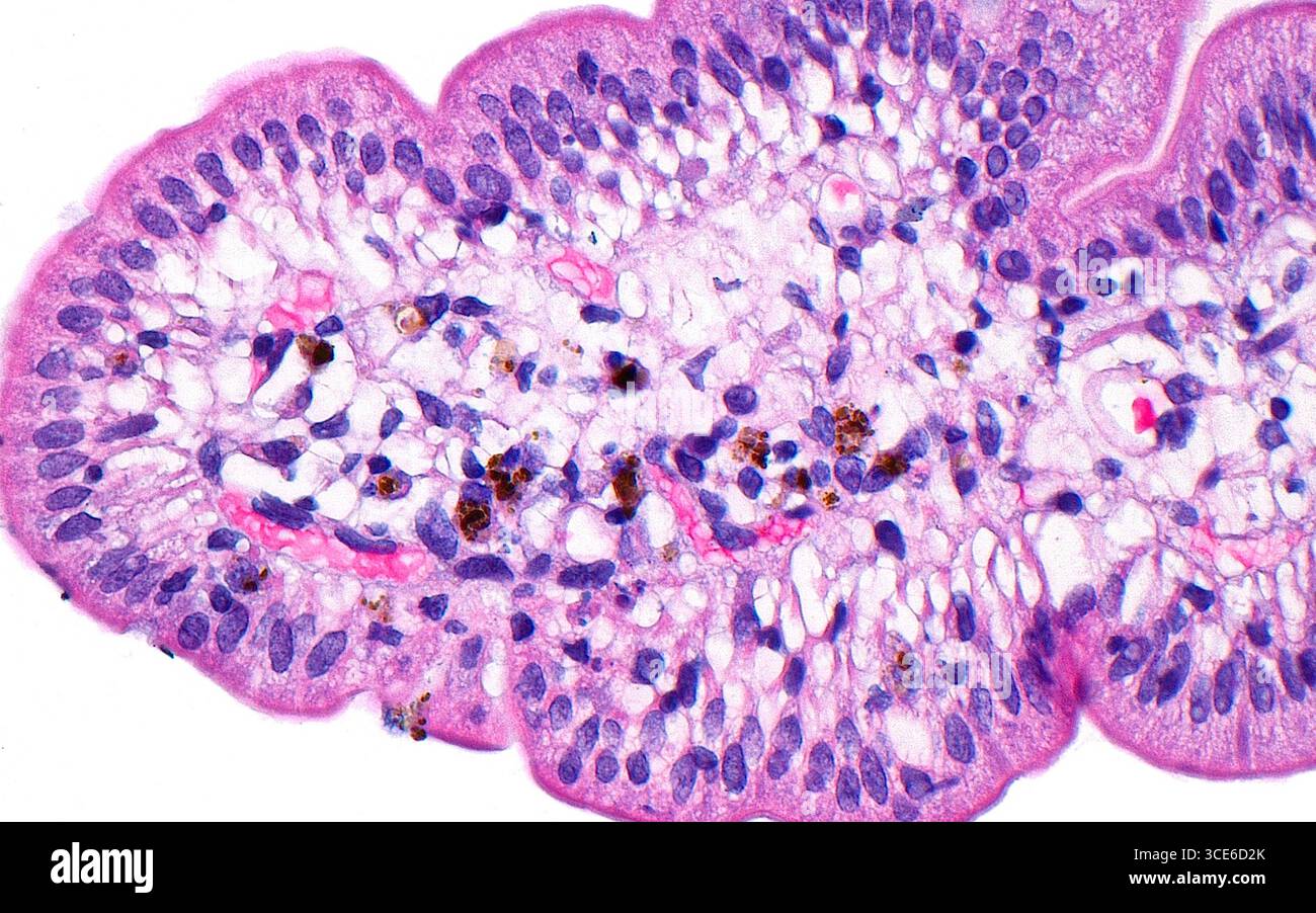 Micrographie à la lumière d'une pseudomélanose duodénale. Dans Pseudomelanose duodéni, le pigment s'accumule dans la lamina propria du duodénum. Cette accumulation de pigments est associée à l'apport en fer, à l'hypertension, au diabète ou à une insuffisance rénale terminale. La structure digitale orientée horizontalement occupant la majeure partie de l'image est une villosité intestinale vue d'une biopsie duodénale. La zone centrale principalement blanche de la villeuse est la lamina propria et le pigment (brun) peut être vu dans la lamina propria. Coupe de tissu colorée à l'hématoxyline et à l'éosine. Grossissement : 400x lorsqu'il est imprimé à 10cm. Banque D'Images
