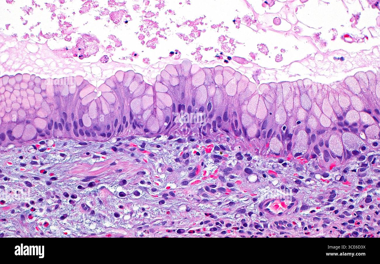 Micrographie à la lumière d'un polype hyperplasique gastrique. Les polypes hyperplasiques dans l'estomac sont doublés de cellules épithéliales avec une coiffe dite de mucine (bleu-rose pâle rond à des structures polygonales). Dans cette image, l'épithélium se déplace horizontalement au centre de l'image. Le tiers inférieur de l'image se compose de tissu conjonctif (brins bleu-rose clair) avec des cellules inflammatoires (points bleus). Les sécrétions (rose clair) sont visibles dans la partie luminale de la glande (tiers supérieur de l'image). Coupe de tissu colorée à l'hématoxyline et à l'éosine. Grossissement : 200x lorsqu'il est imprimé à 10cm. Banque D'Images