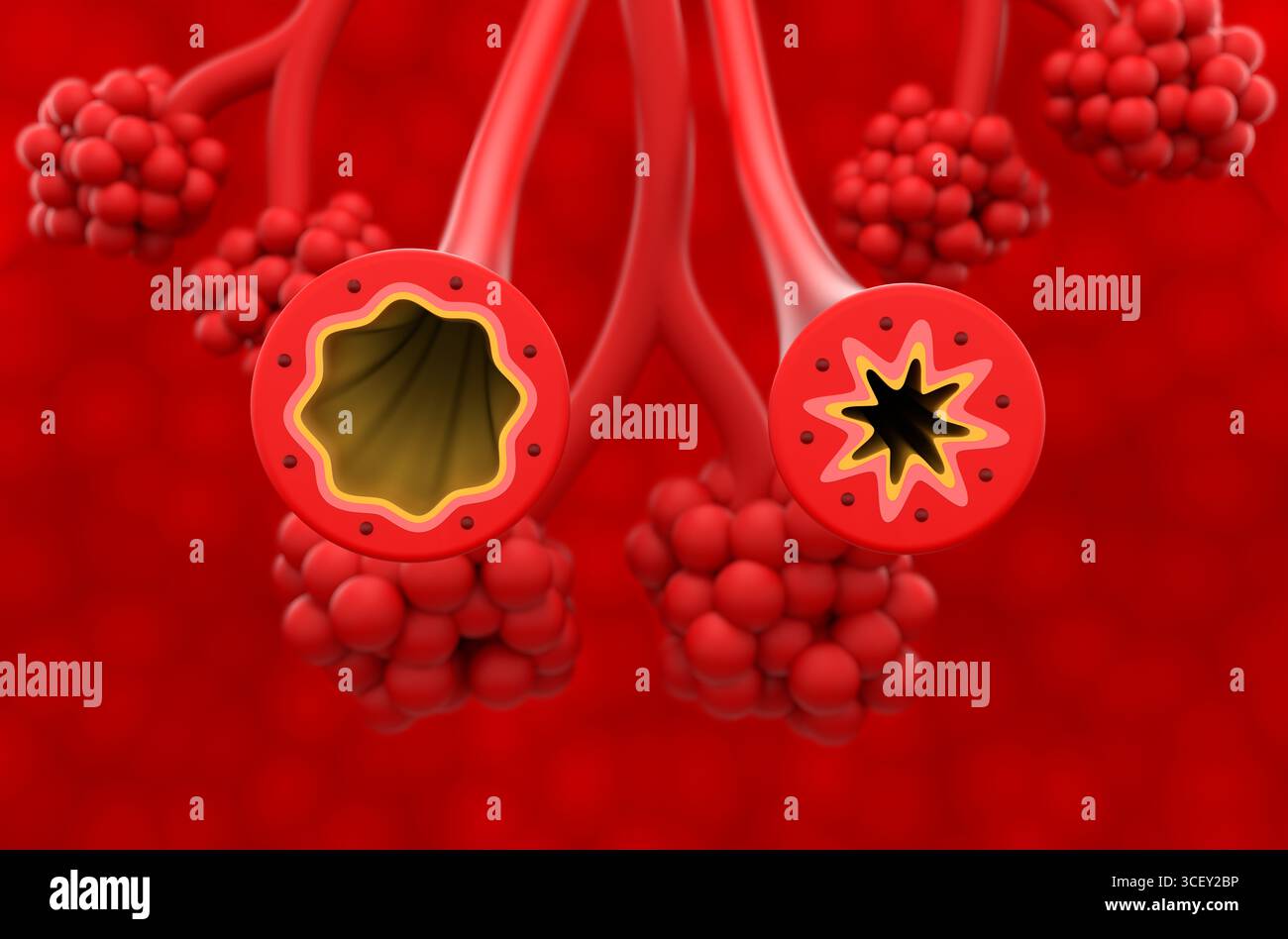 Tube bronchique normal et asthmatique dans le poumon - vue isométrique illustration 3D. Banque D'Images
