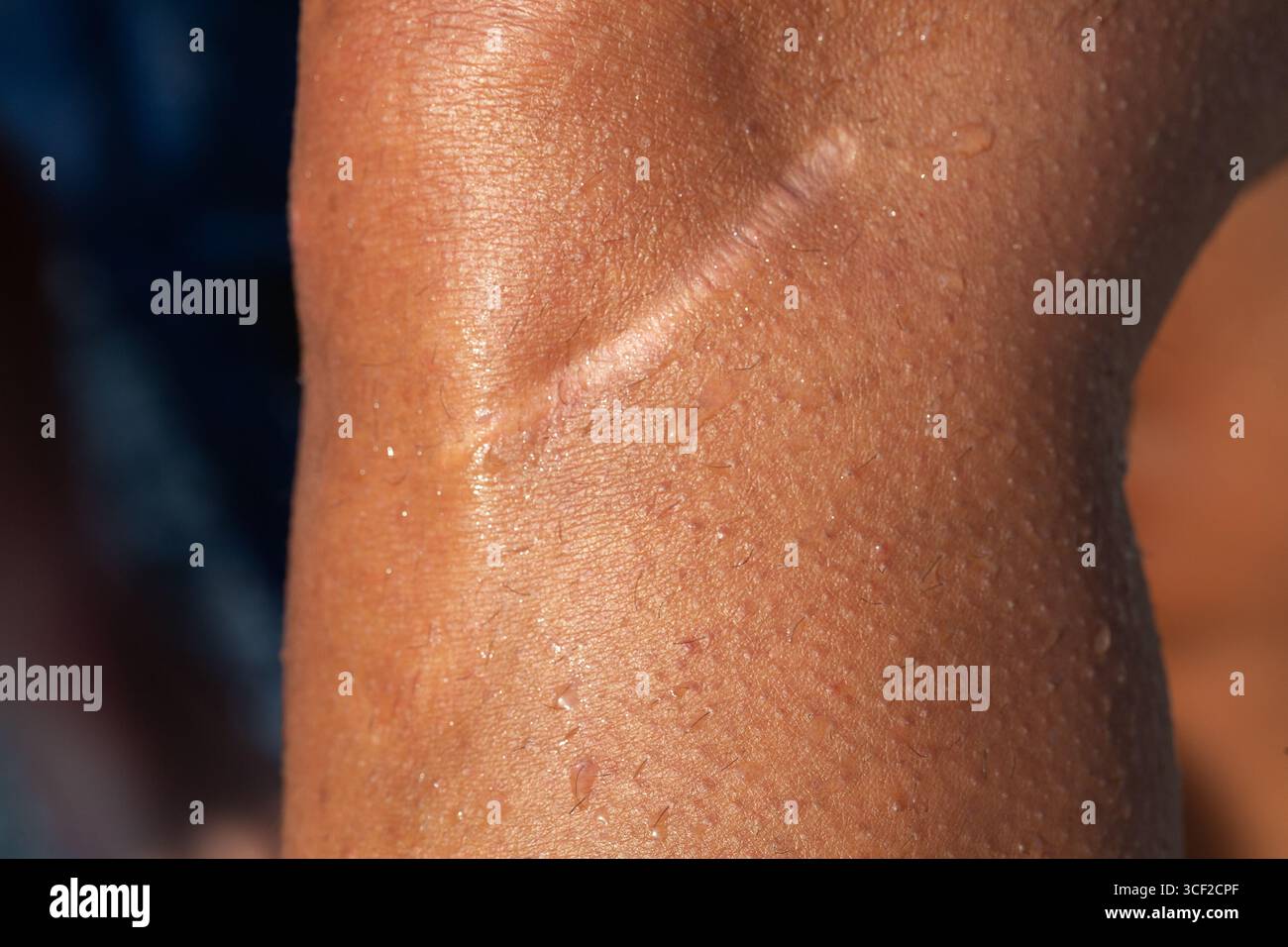 Gros plan d'une cicatrisation postopératoire sur peau en sueur, mettant en évidence la santé de la peau et la récupération médicale Banque D'Images