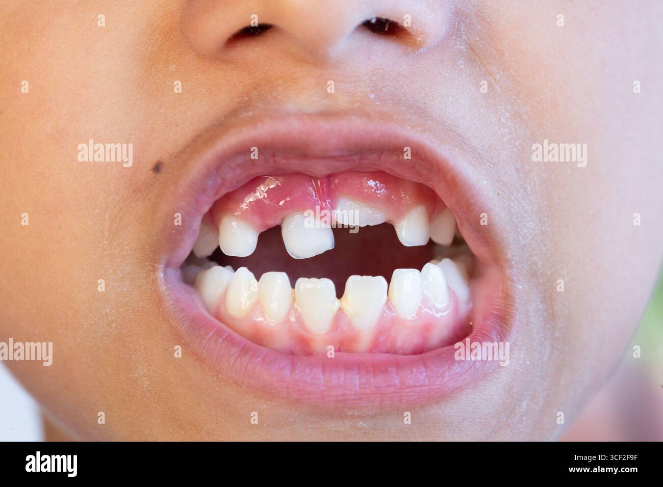 Dentier Cosmétique Fausses Dents en Silicone Facette Dentaire Sourire