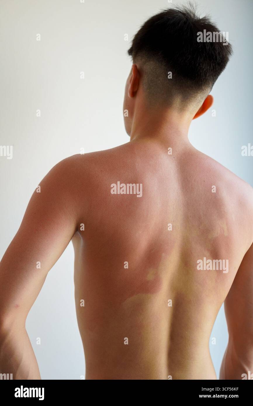 L'épaule brûlée par le soleil d'un jeune homme Banque D'Images