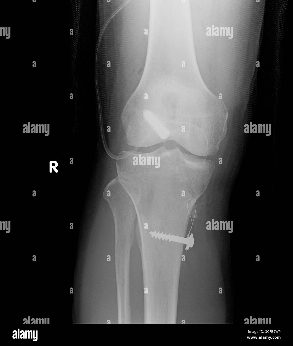 Processus opératoire filmé de la vue AP du genou droit. Vis de fixation au fémur distal et au tibia proximal, tube de drainage retenu. Banque D'Images