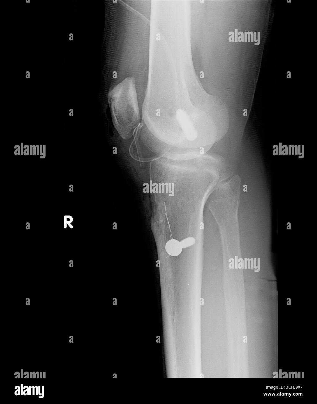 Processus opératoire filmé de la vue latérale du genou droit. Vis de fixation au fémur distal et au tibia proximal, tube de drainage retenu. Banque D'Images