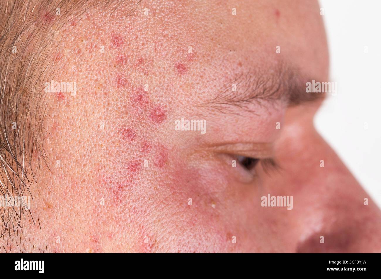 Taches rouges et éruptions cutanées sur le cuir chevelu et les yeux. Intolérance à l'alcool, urticaire alcoolique, allergies. Banque D'Images