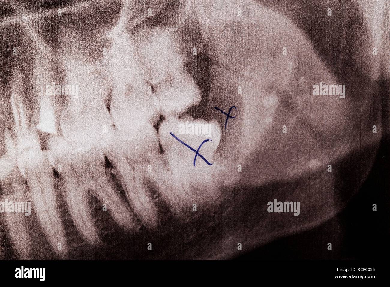 une dent de sagesse extraite avec un kyste purulent barré avec un stylo sur une radiographie Banque D'Images