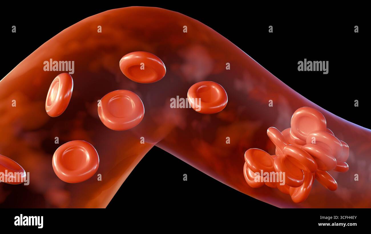 Illustration médicale 3D d'un vaisseau sanguin avec formation d'un caillot sanguin. Banque D'Images