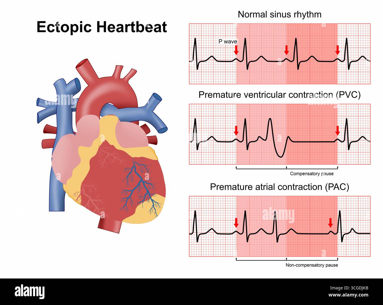 Illustration médicale de flashcard de battement de coeur ectopique Banque D'Images