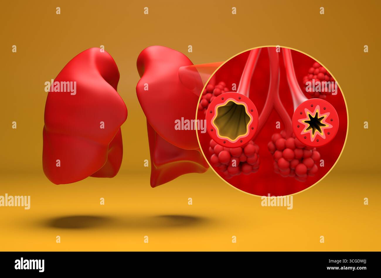 Tube bronchique normal et asthmatique dans le poumon - vue isométrique illustration 3D. Banque D'Images