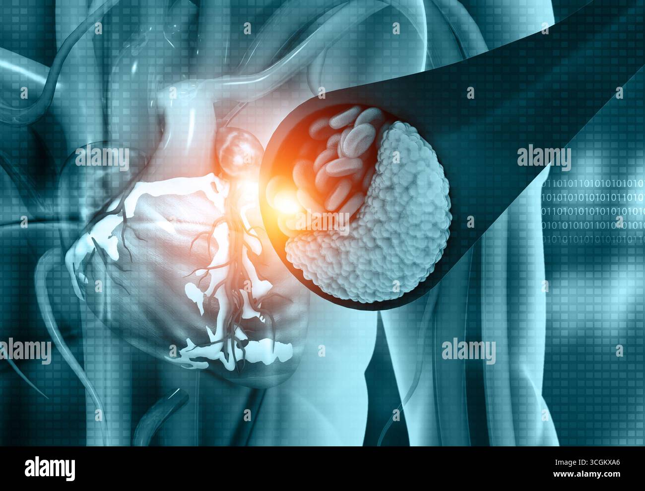 Coronaropathie. Coeur avec artères bloquées. illustration 3d. Banque D'Images