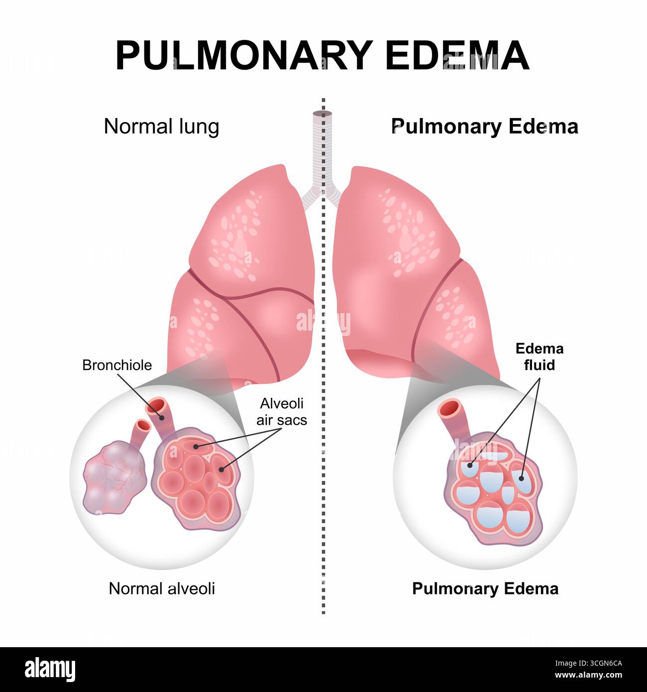 Œdème pulmonaire Flashcard illustration médicale du poumon Banque D'Images