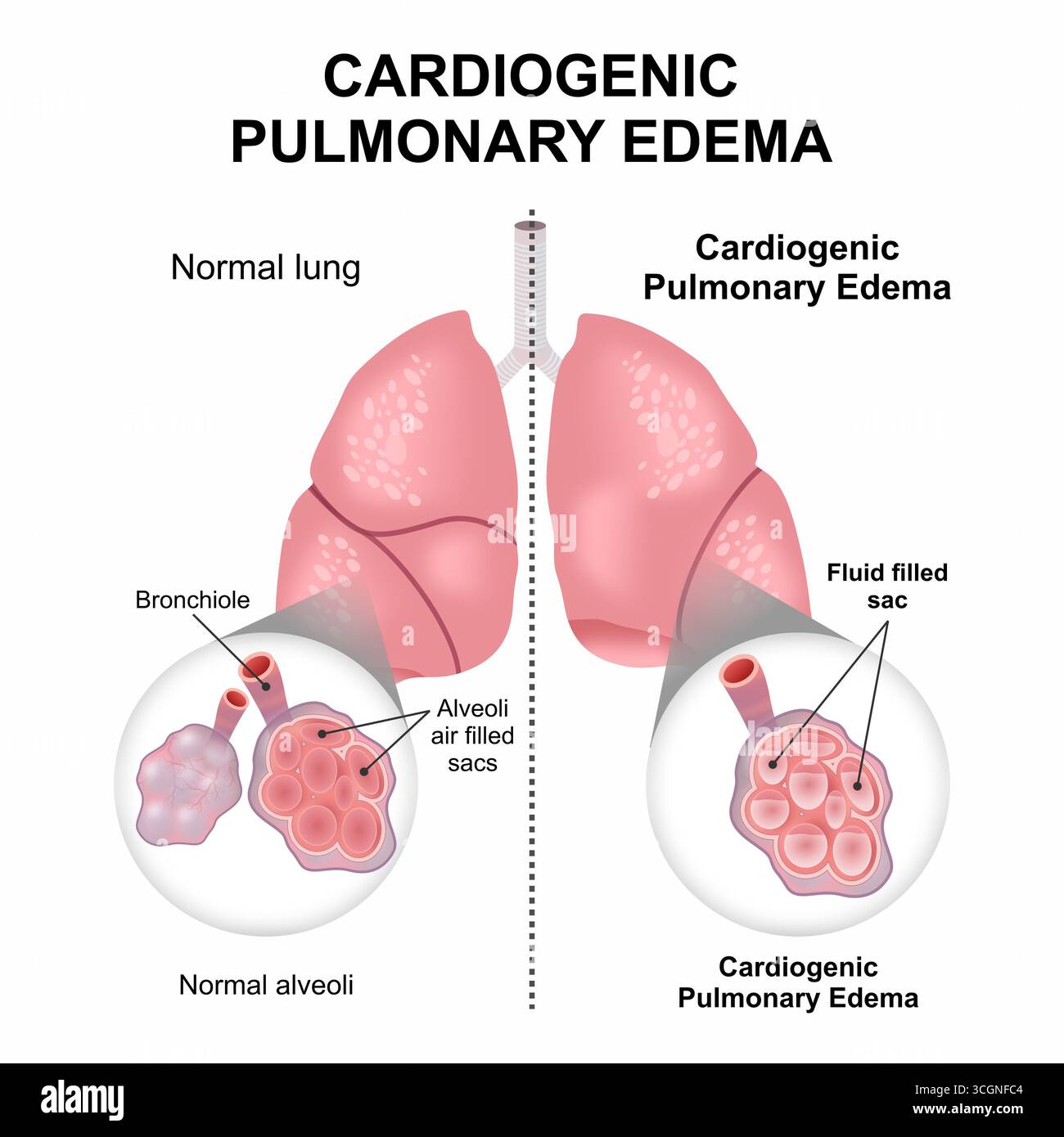 Oedème pulmonaire cardiogénique illustration en flashcard poumon Banque D'Images