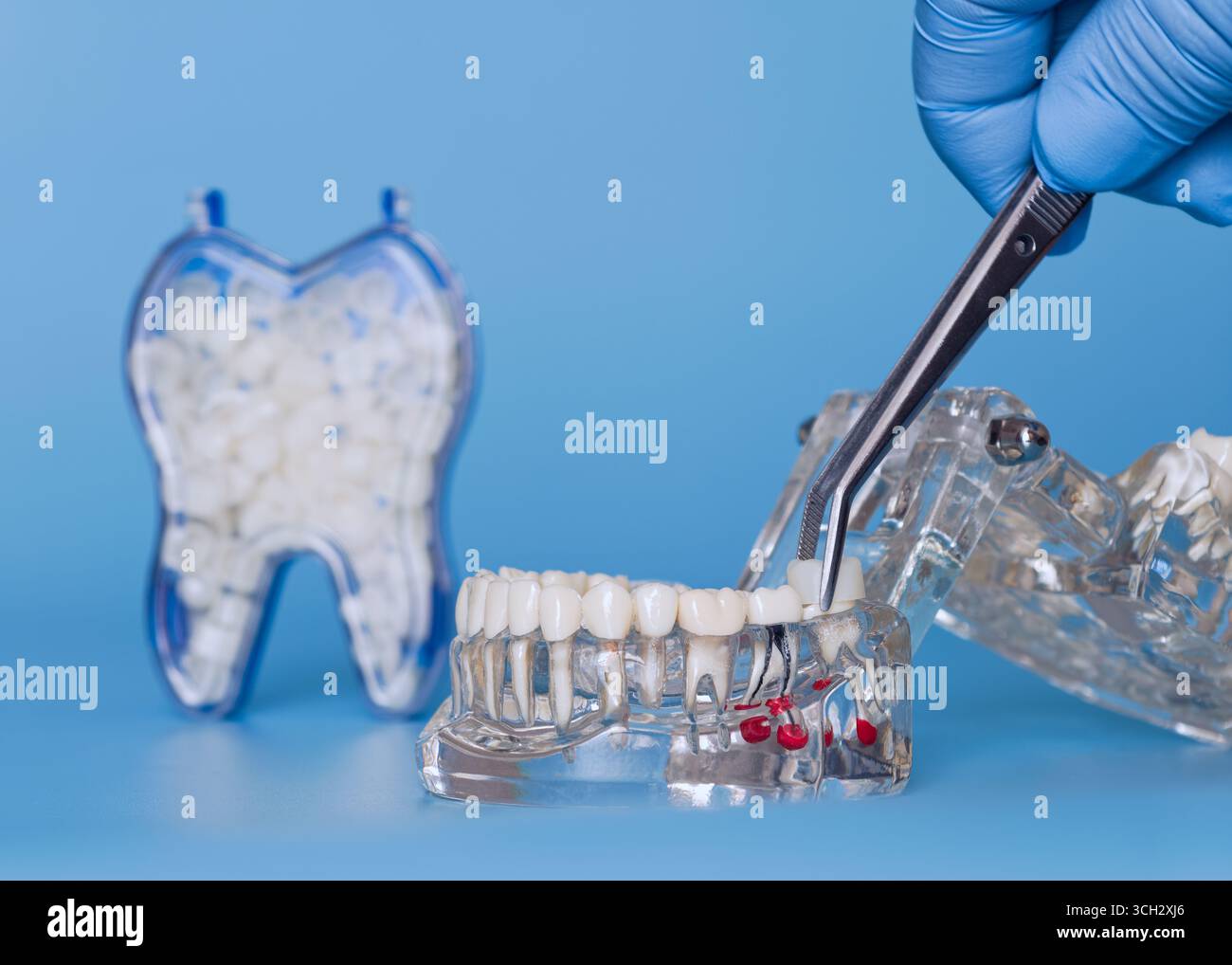 Main gantée à l'aide d'une pince à épiler pour positionner une couronne dentaire sur un modèle de mâchoire transparent, avec récipient de dents de rechange en arrière-plan. Banque D'Images