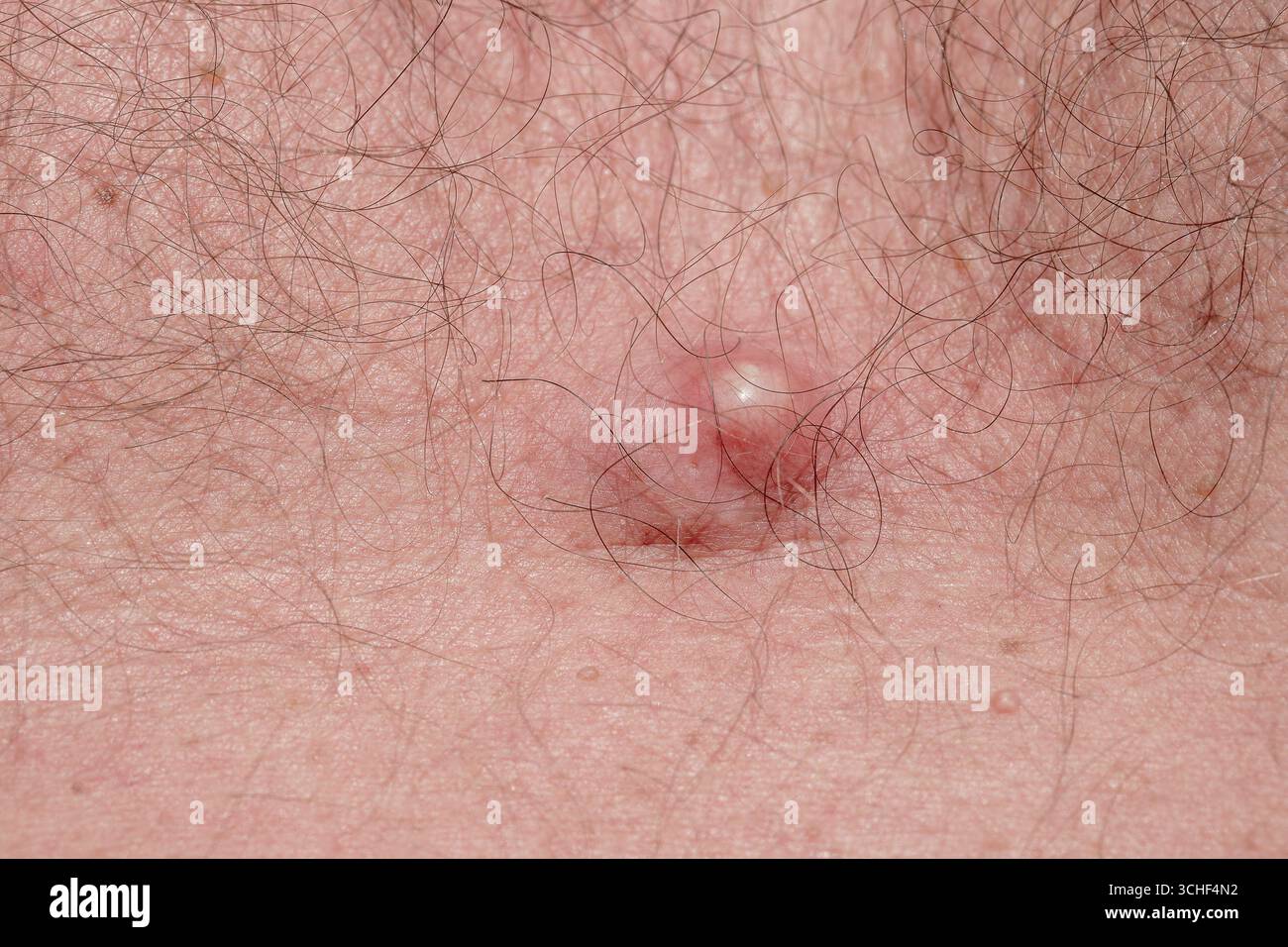 Acné sur la peau du corps, maladie dermatologique acné, gros plan Banque D'Images