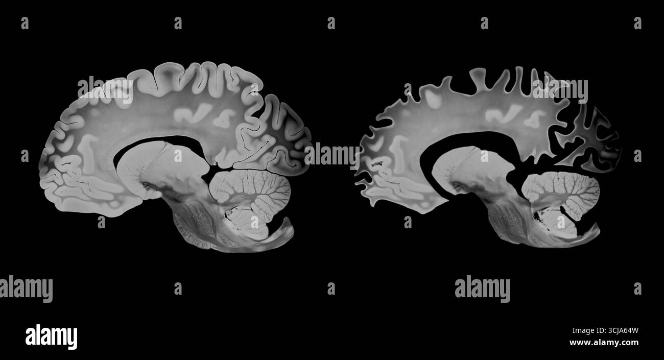Comparaison du cerveau Alzheimer en vue sagittale montrant les différences entre un cerveau sain et atteint, mettant en évidence l'atrophie corticale et le neurodégénérat Banque D'Images