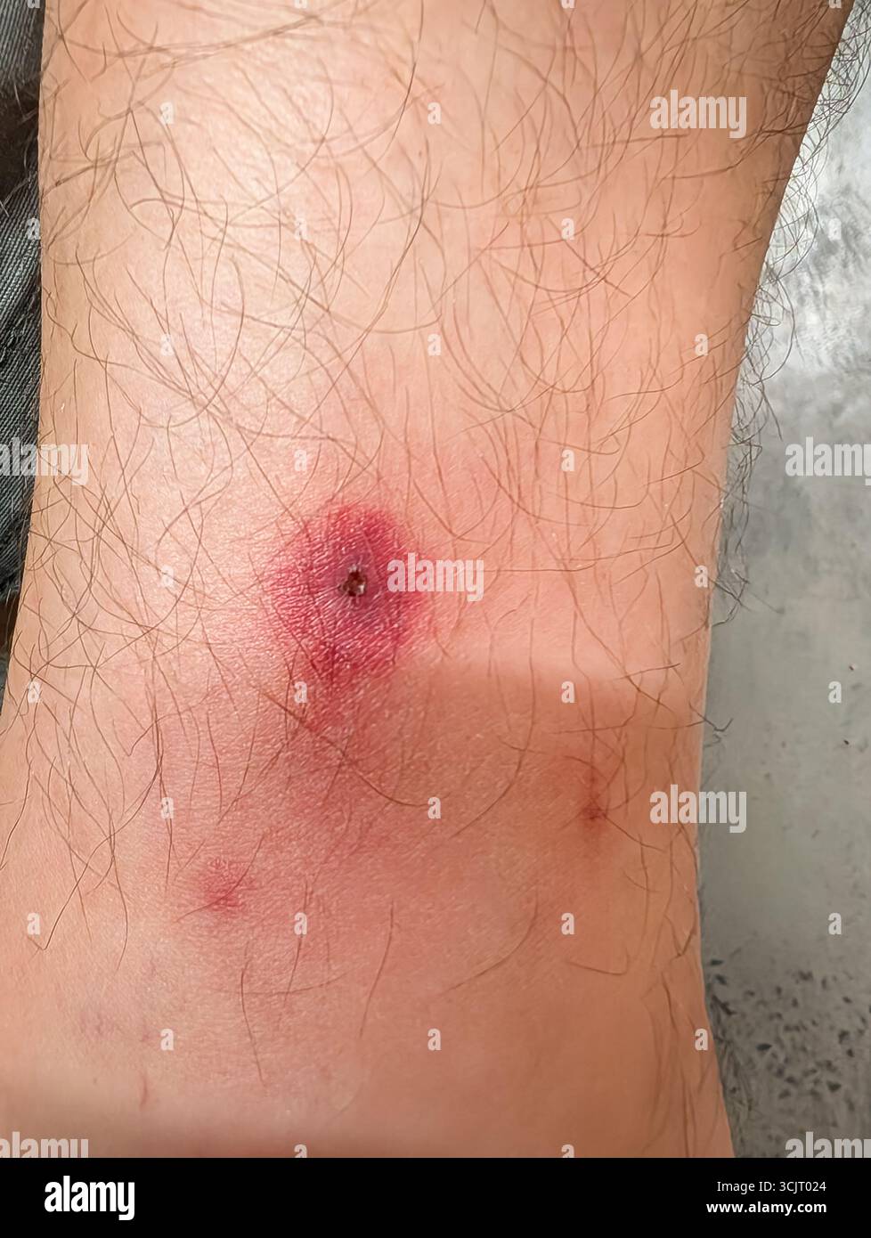 Gros plan macro d'une piqûre d'insecte sévère, rouge et enflammée avec une piqûre centrale sur la jambe poilue d'une personne, montrant une réaction allergique douloureuse Banque D'Images