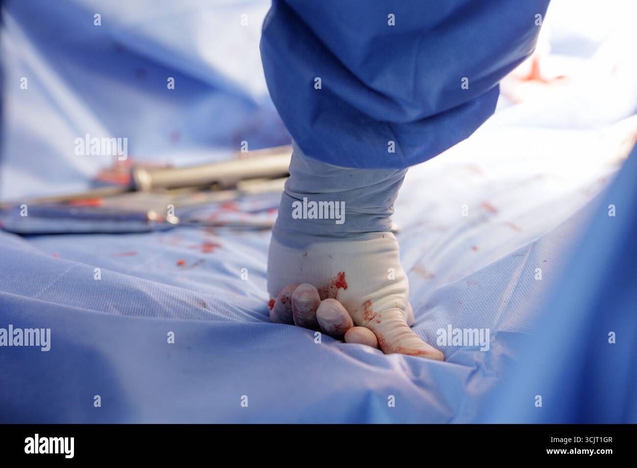 Gros plan sur un gant chirurgical taché de sang pressant un champ stérile bleu pendant l'hémostase, idéal pour la sécurité EN SALLE D'OPÉRATION, les protocoles de traumatologie et la formation médicale Banque D'Images