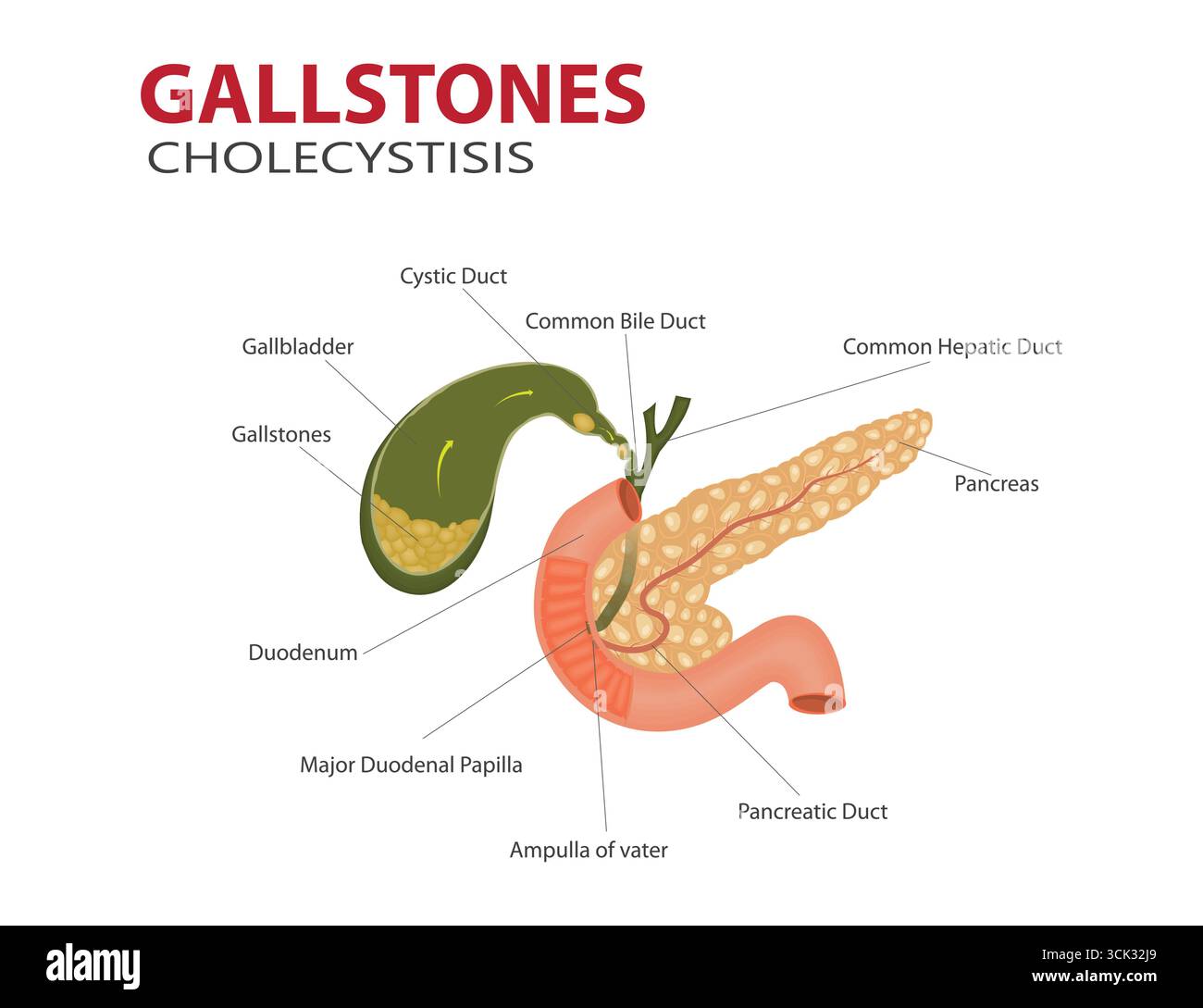Illustration médicale de calculs biliaires et de cholécystites dans la vésicule biliaire avec anatomie digestive marquée. Illustration de Vecteur