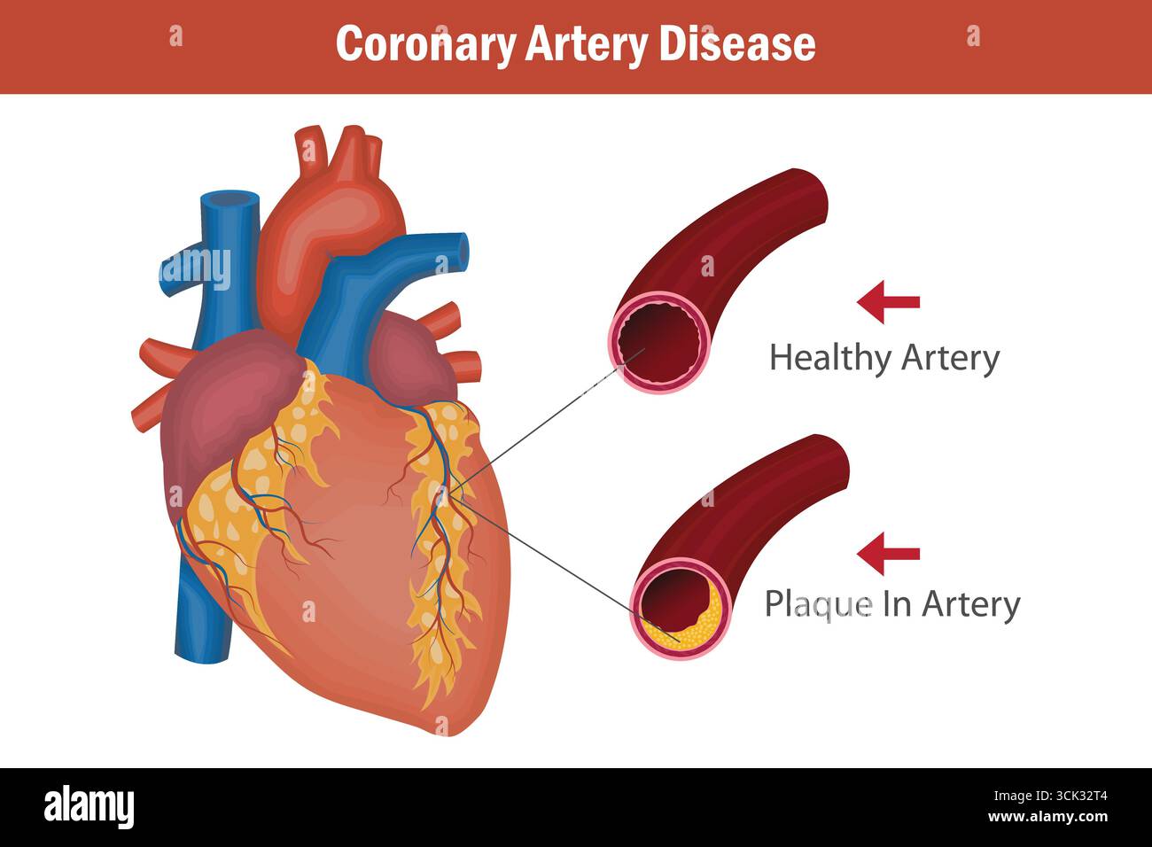 Illustration comparant une artère saine à une artère rétrécie dans la coronaropathie. Illustration de Vecteur