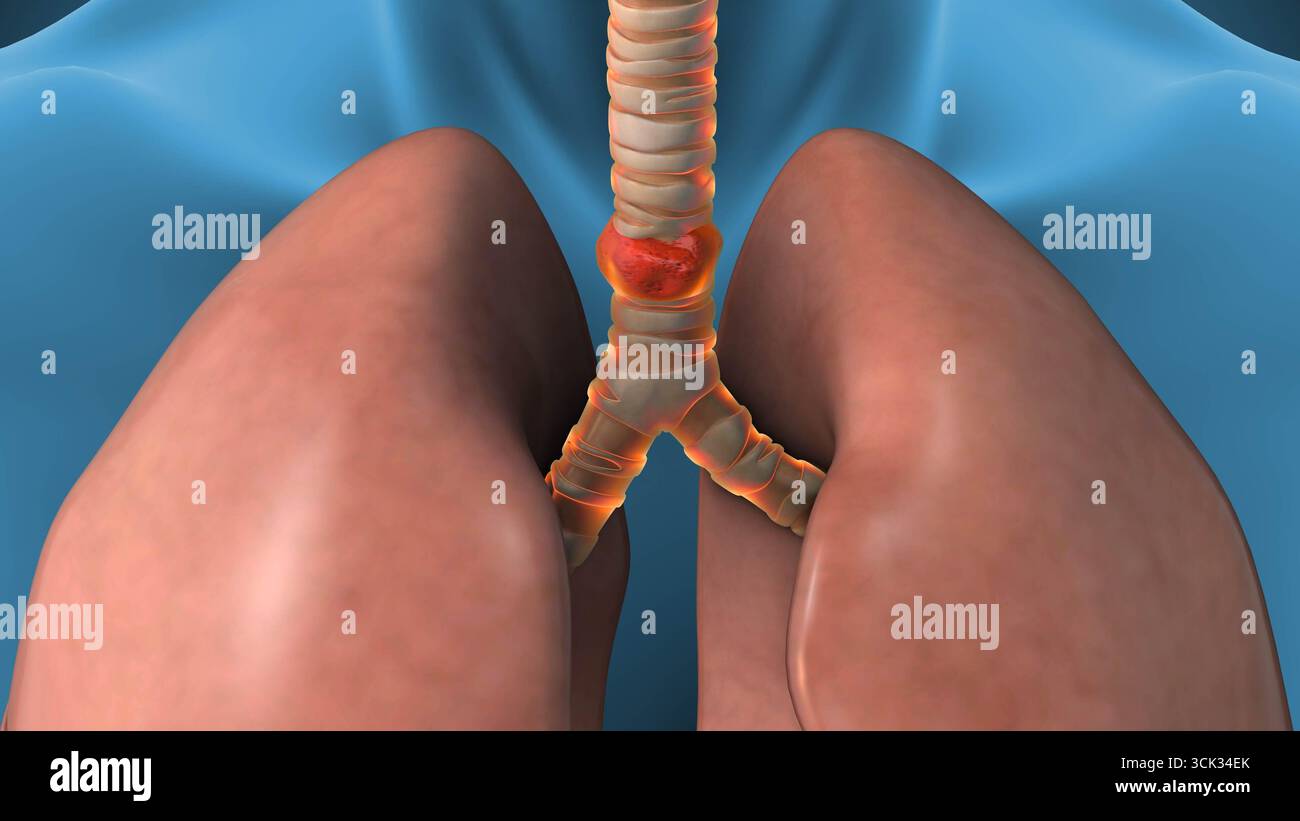 Syndrome douloureux trachéal infectieux Banque D'Images