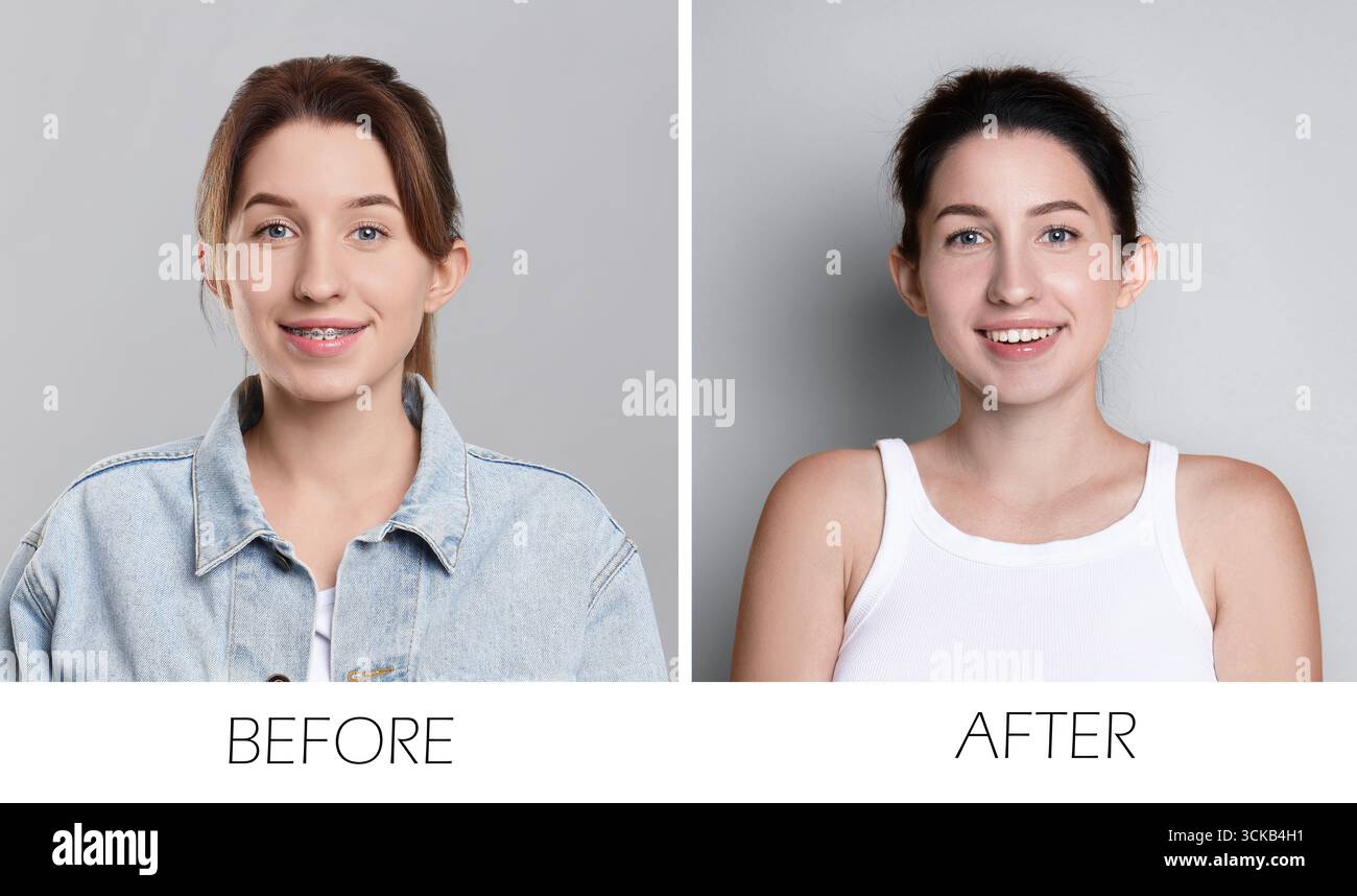Collage avec des photos de femme avec des appareils dentaires et des dents parfaites sur fond gris. Avant et après Banque D'Images